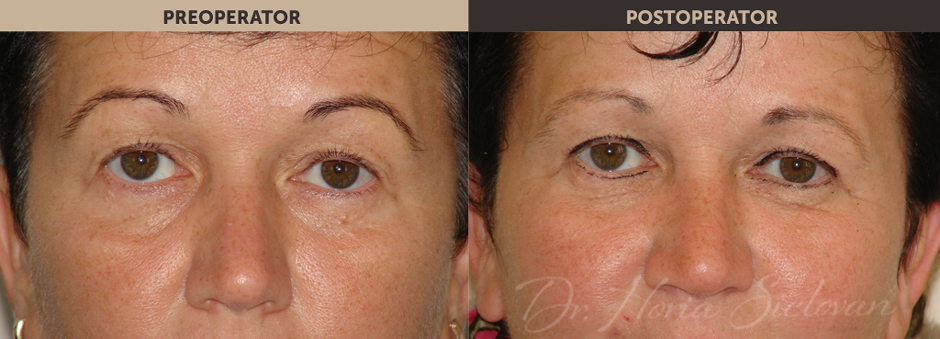 Blefaroplastie poze