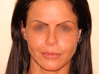 Case 1 - Lipofilling