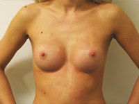 Cazul 31: Augmentare mamara subfasciala, implanturi rotunde Mentor® 200 cm³