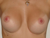 Cazul 32: Augmentare mamara subfasciala, implanturi rotunde Mentor® 225 cm³