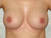 Cazul 39: Augmentare mamara subfasciala, implanturi anatomice Mentor® 300 cm³