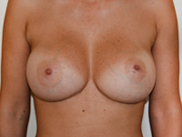 Cazul 72: Augmentare mamara (tehnica muscle splitting biplane) si mamopexie interna, implanturi anatomice Mentor® 380 cm³