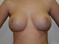 Caz 79: Augmentare mamara (tehnica muscle splitting biplane), implanturi anatomice Mentor® 380 cm³