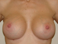 Case 15 : Muscle splitting biplane breast augmentation, Mentor® anatomical implants 380 cc after 18 months breastfeeding