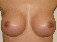 Case 16 : Muscle splitting biplane breast augmentation, Mentor® anatomical implants 380 cc
