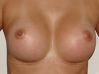 Case 22 : Subfascial breast augmentation, Mentor® anatomical implants 350 cc
