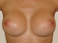 Case 25 : Muscle splitting biplane breast augmentation, Mentor® anatomical implants 330 cc