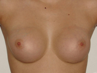 Case 27 : Subfascial breast augmentation, Mentor® anatomical implants 225 cc