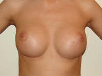 Case 29 : Subfascial breast augmentation, Mentor® round implants 275 cc