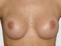 Case 30 : Subfascial breast augmentation, Mentor® round implants 175 cc