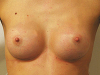 Case 31 : Subfascial breast augmentation, Mentor® round implants 200 cc