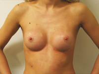 Case 31 : Subfascial breast augmentation, Mentor® round implants 200 cc