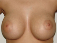 Case 33 : Subfascial breast augmentation, Mentor® round implants 350 cc