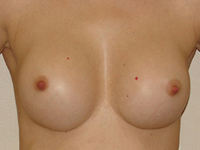 Case 35 : Subfascial breast augmentation, Mentor® round implants 275 cc