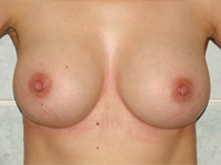 Case 39 : Subfascial breast augmentation, Mentor® anatomical implants 300 cc