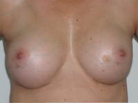Case 40 : Subfascial breast augmentation, Mentor® anatomical implants 260 cc