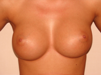 Case 4 : Subfascial breast augmentation, Mentor® anatomical implants 380 cc