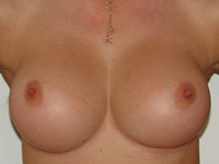 Case 43 : Muscle splitting biplane breast augmentation, Mentor® anatomical implants 330 cc