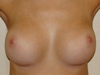 Case 44 : Muscle splitting biplane breast augmentation, Mentor® anatomical implants 290 cc