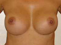 Case 46 : Muscle splitting biplane breast augmentation, Mentor® anatomical implants 330 cc