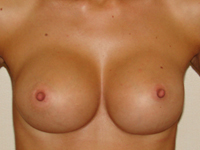 Case 48 : Muscle splitting biplane breast augmentation, Mentor® anatomical implants 330 cc