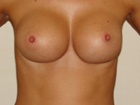 Case 48 : Muscle splitting biplane breast augmentation, Mentor® anatomical implants 330 cc