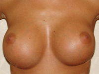 Case 49 : Muscle splitting biplane breast augmentation, Mentor® anatomical implants 330 cc