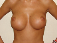 Case 49 : Muscle splitting biplane breast augmentation, Mentor® anatomical implants 330 cc