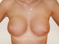 Case 62 : Muscle splitting biplane breast augmentation, Mentor® anatomical implants 330 cc