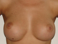 Case 7 : Subfascial breast augmentation, Mentor® anatomical implants 330 cc