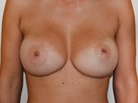 Case 72 : Muscle splitting biplane breast augmentation with internal mastopexy, Mentor® anatomical implants 380 cc