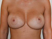 Case 72 : Muscle splitting biplane breast augmentation with internal mastopexy, Mentor® anatomical implants 380 cc
