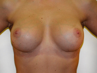 Case 77 : Muscle splitting biplane breast augmentation, Mentor® anatomical implants 380 cc