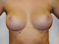 Case 78 : Muscle splitting biplane breast augmentation, Mentor® anatomical implants 330 cc
