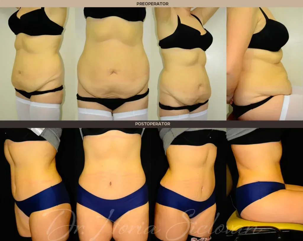 Caz 1: Abdominoplastie