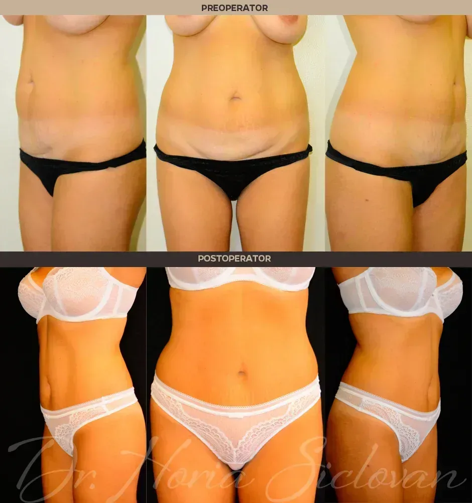 Caz 6: Abdominoplastie