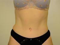 Caz 7: Abdominoplastie
