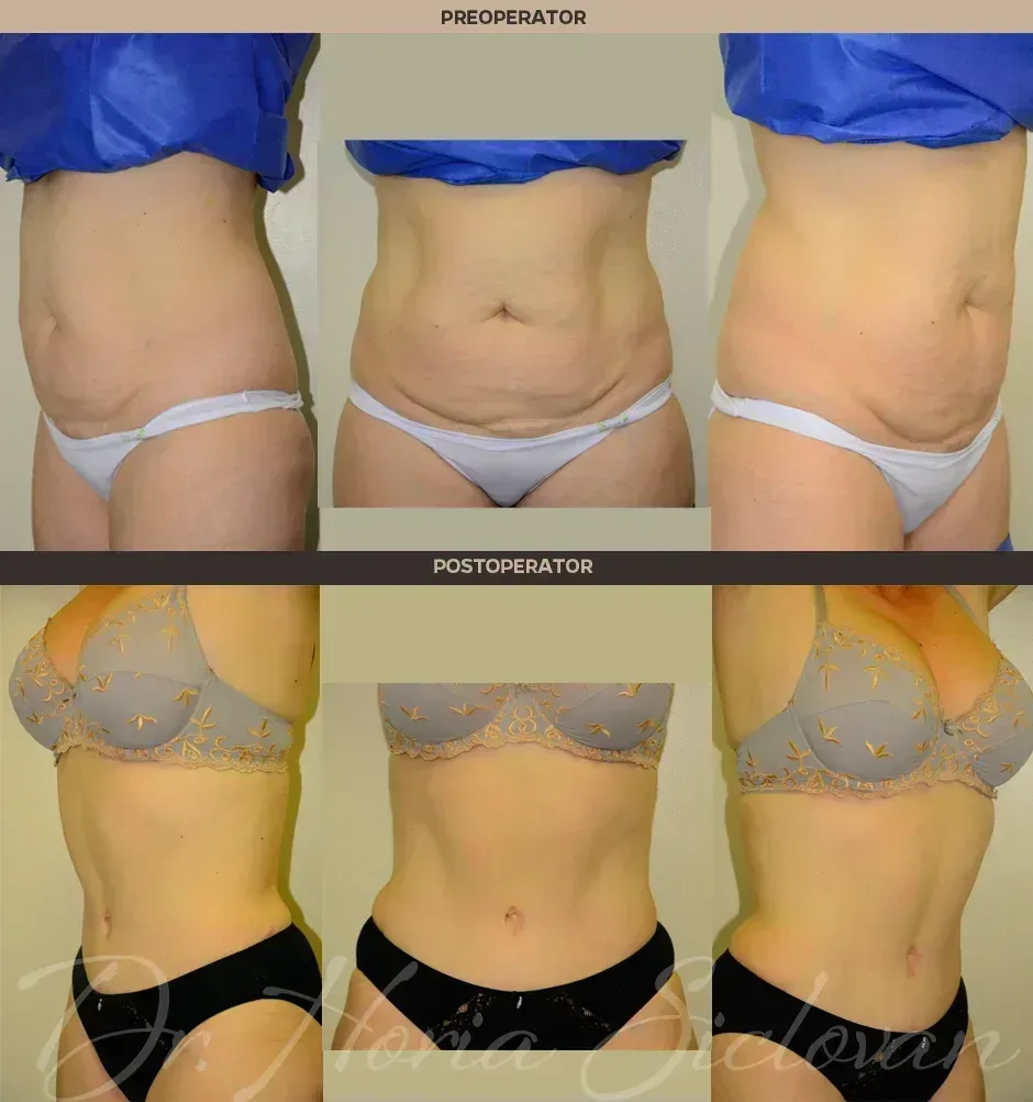 Caz 7: Abdominoplastie