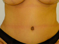abdominoplastia-cazul-11-vechi-eng1