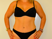 Caz 5: Abdominoplastie
