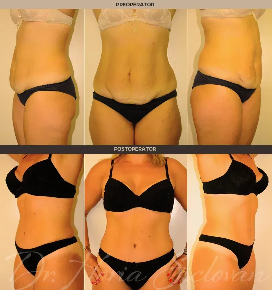 Caz 5: Abdominoplastie