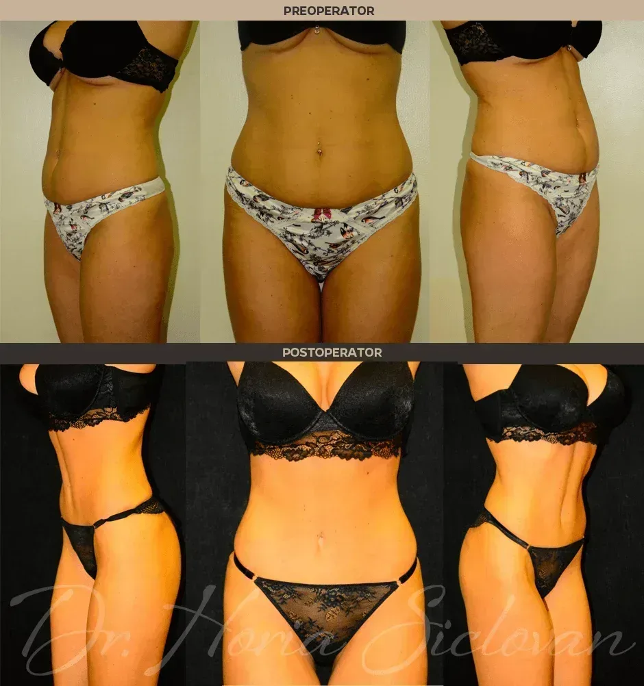 Caz 2: Abdominoplastie