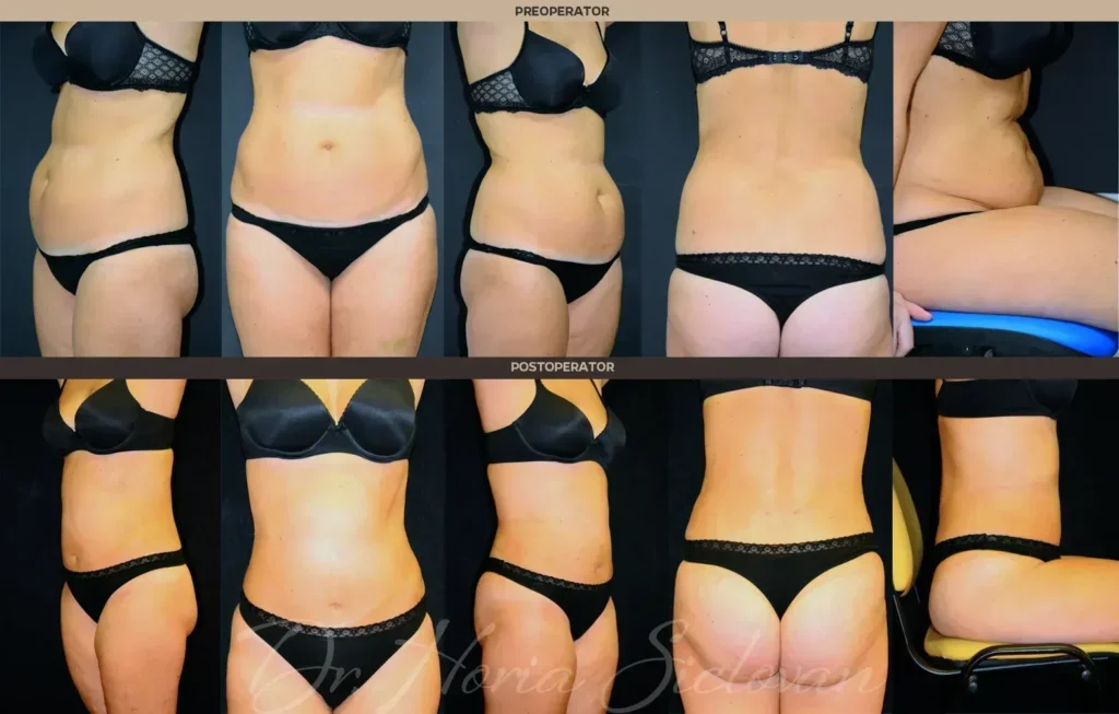 Caz 3: Abdominoplastie