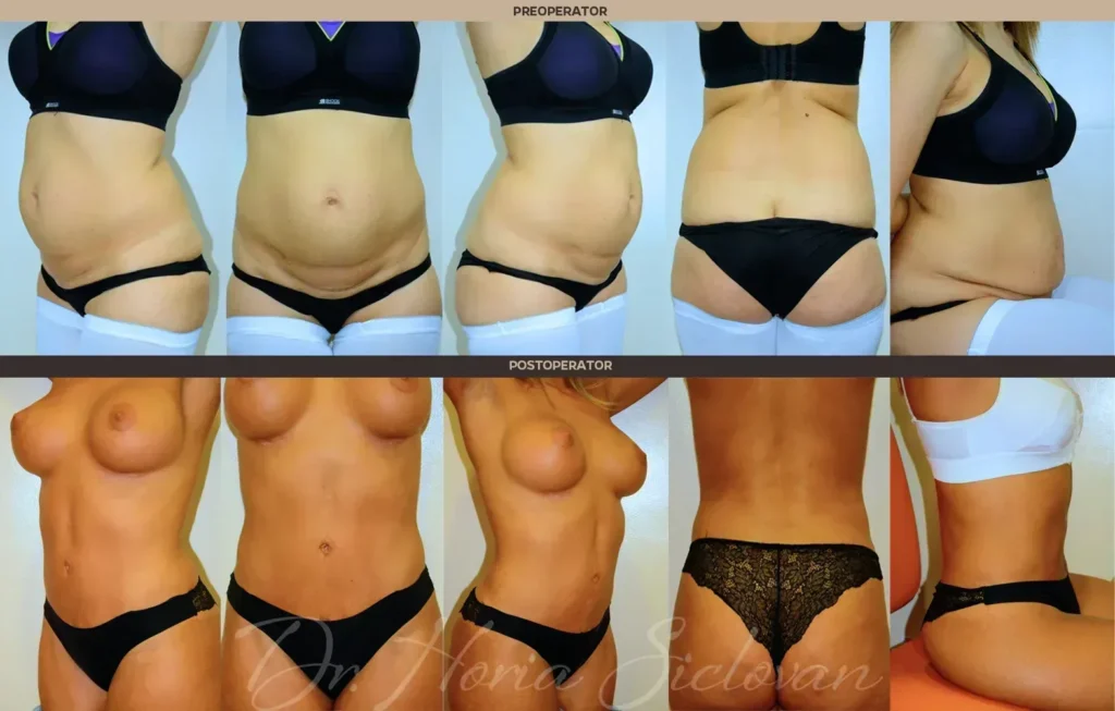 Caz 4: Abdominoplastie