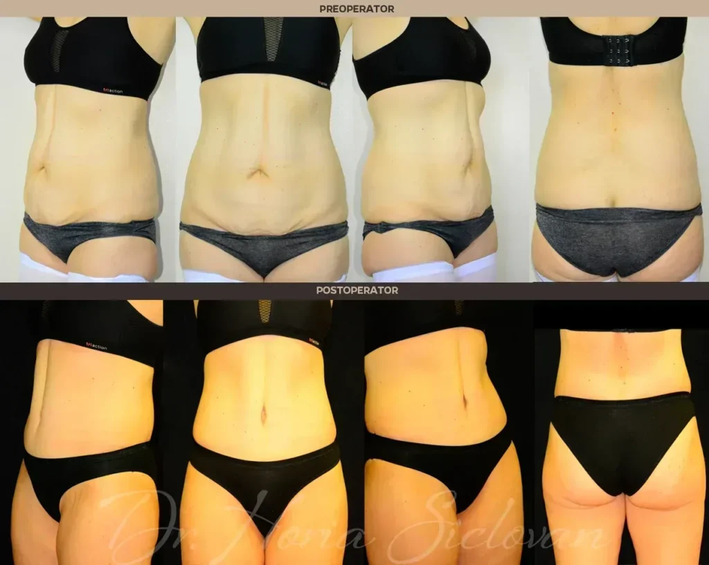 Caz 8: Abdominoplastie