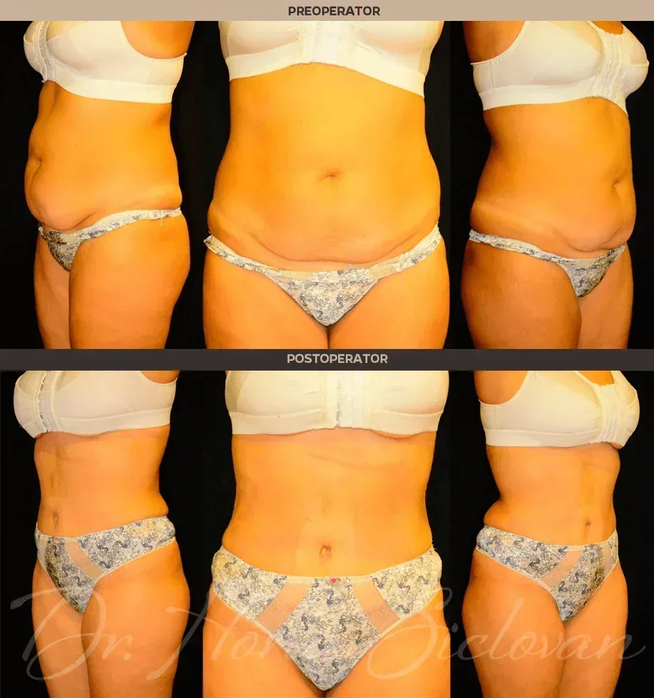 Caz 9: Abdominoplastie