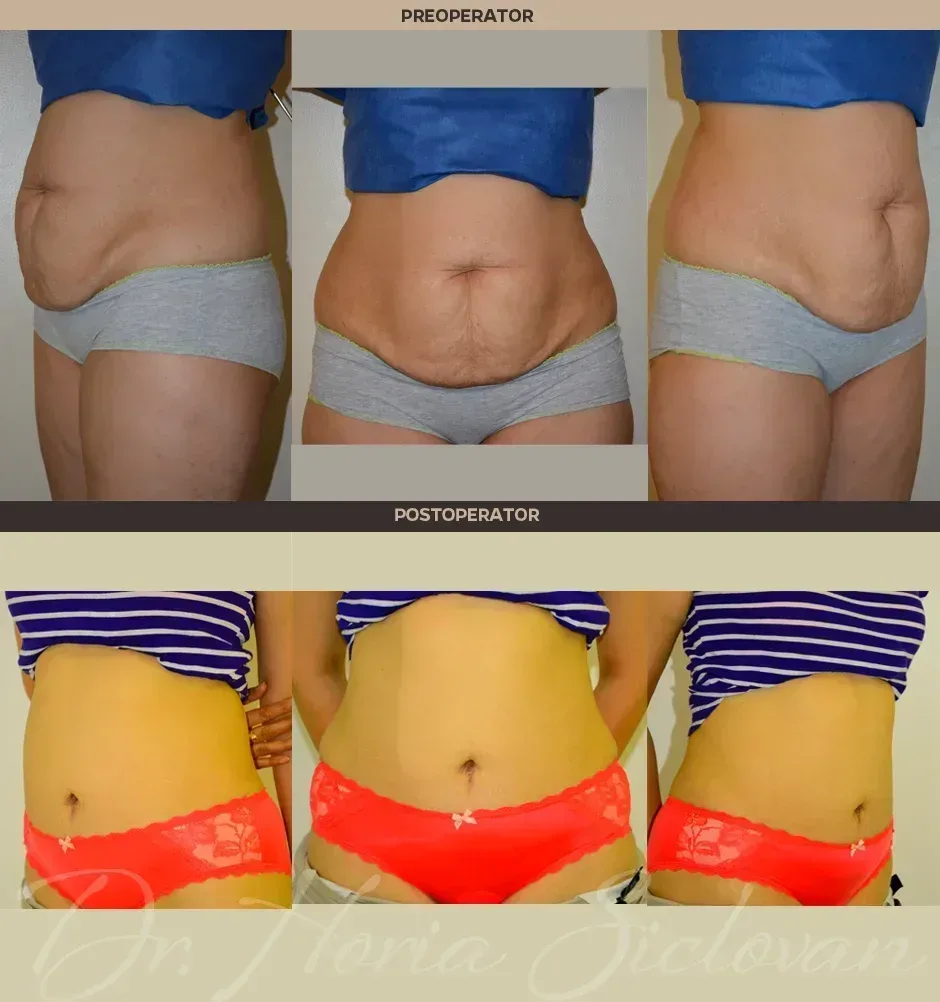 Caz 10: Abdominoplastie
