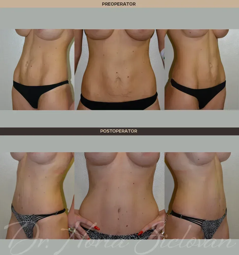 Caz 11: Abdominoplastie