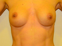 Caz 59: Augmentare mamara (tehnica muscle splitting biplane), implanturi anatomice Mentor® 270 cm³