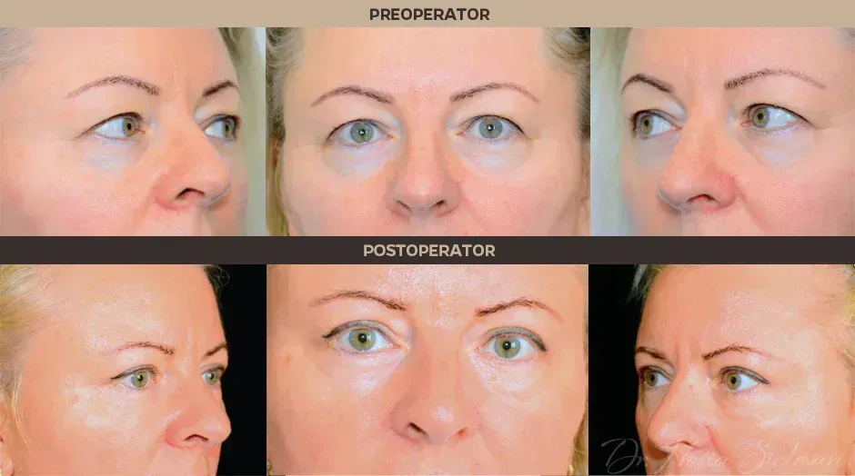 Case 4 - Blepharoplasty